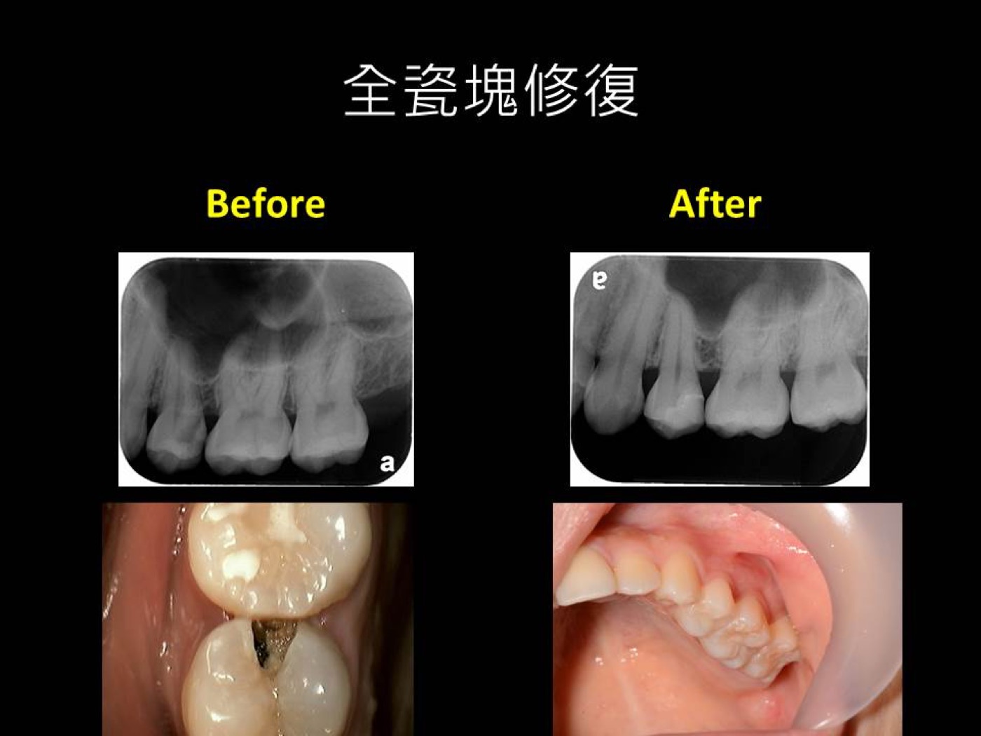 復形治療案例案例圖