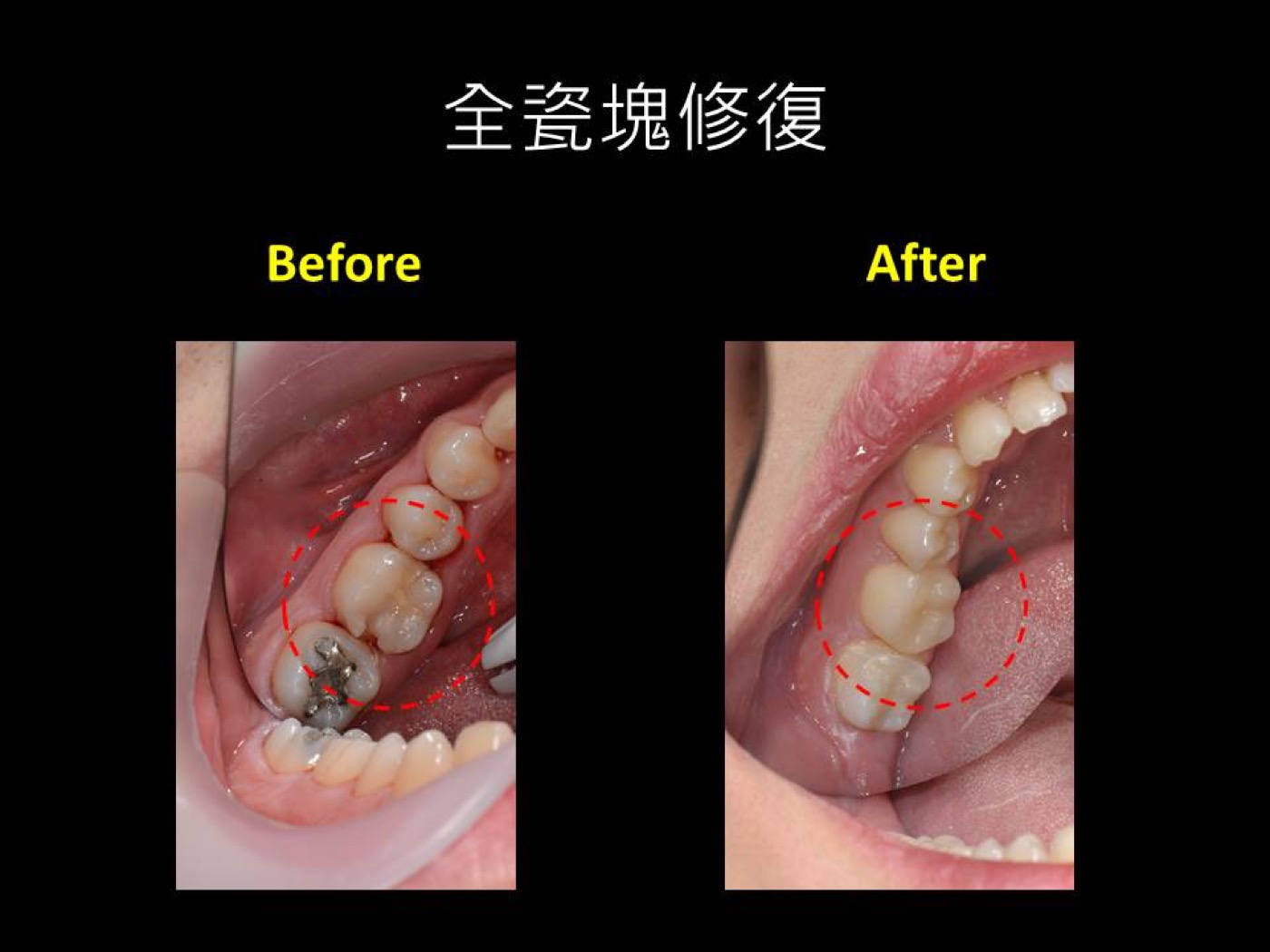 復形治療案例圖例 2