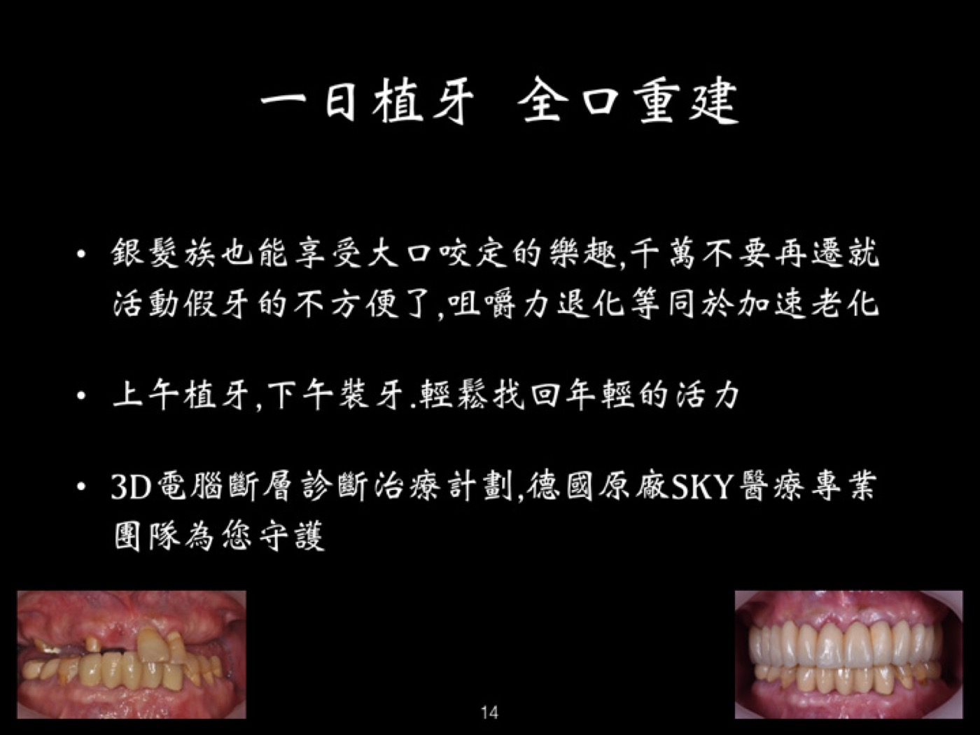 一日植牙全口重建案例圖例 2
