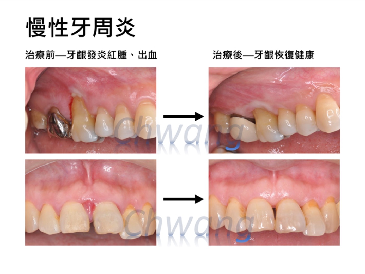 牙周治療案例案例圖