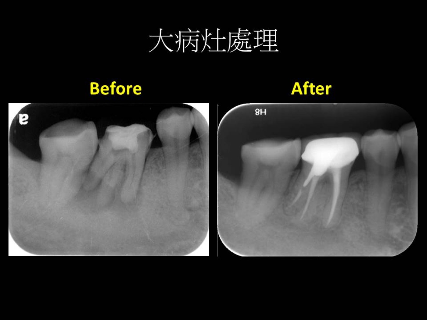 根管治療案例圖例 2