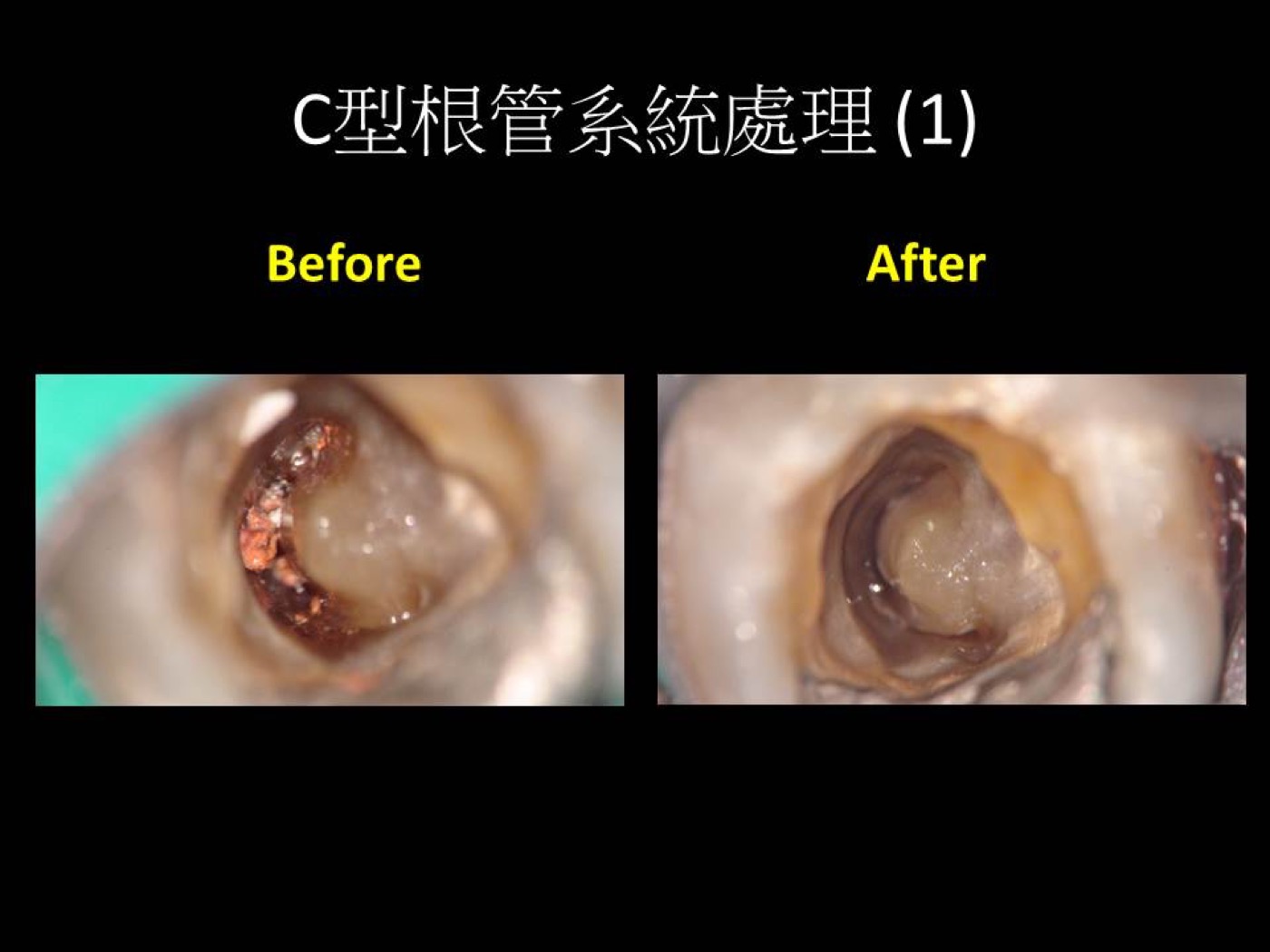 根管治療案例圖例 3
