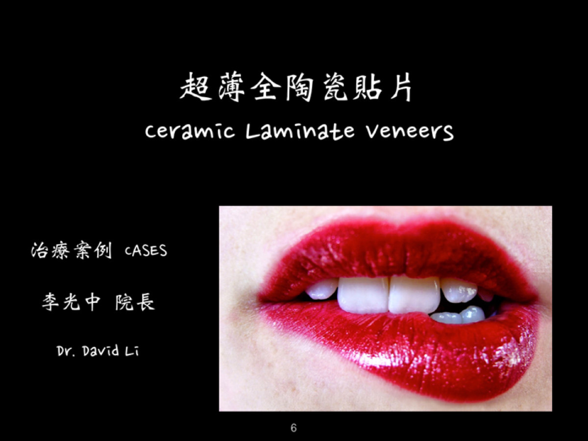 全瓷冠／貼片示意圖